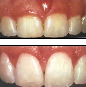 treatment of gums ingivectomy 1