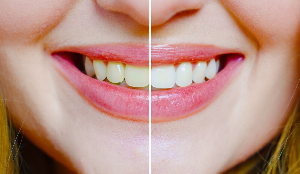The Importance of Cleaning Teeth : A Gateway to Optimal Oral Health