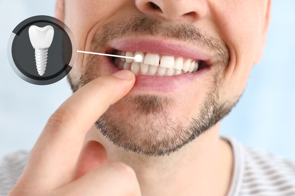 Problems and Complications with Dental Implants