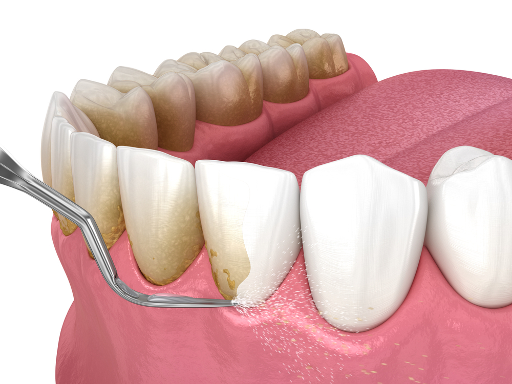 Discoloration of Teeth – Clean Up Those Discolored, Yellow Teeth