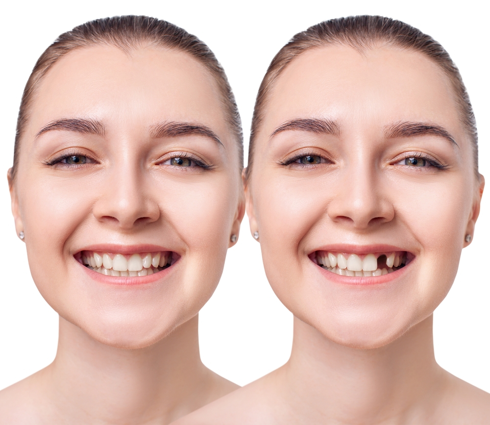 Embarrassed With Your Teeth? You Need a Smile Makeover