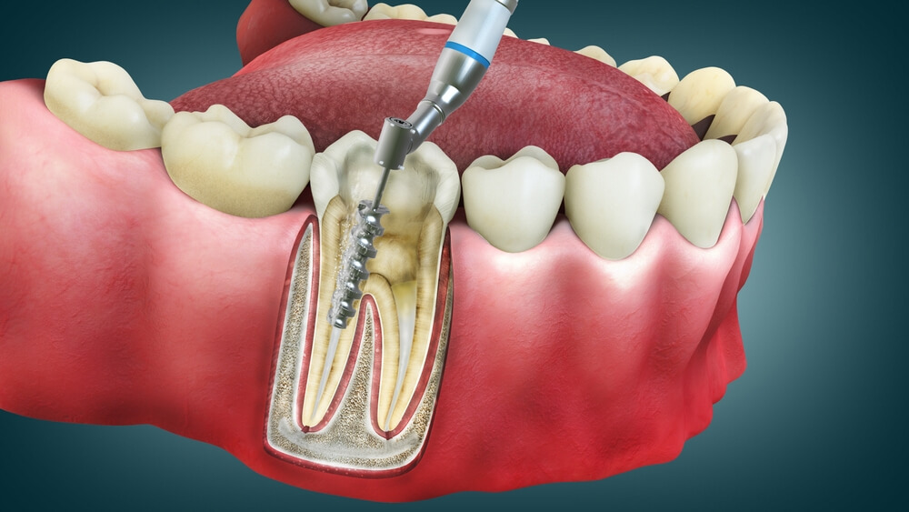 Unveiling Root Canal Treatment: What You Need to Know