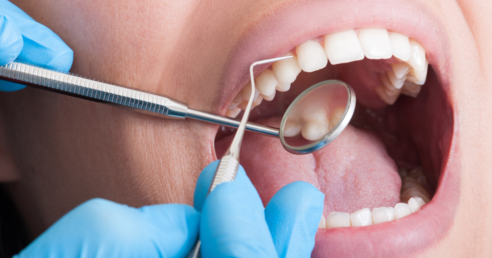 Teeth Care Centre in Ahmedabad : Expert Cleaning to Braces