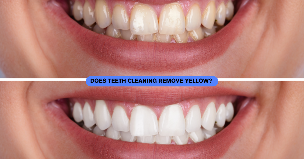 Does Teeth Cleaning Remove Yellow? A Comprehensive Guide