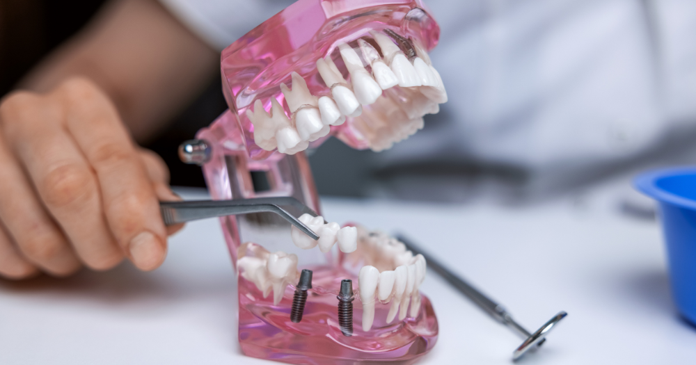 Debunking Myths About Dental Crowns and Bridges